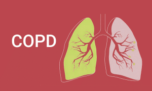 COPD Definition and Diagnosis